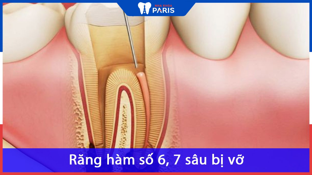 Răng hàm số 6 sâu bị vỡ có nên nhổ không?Bác sĩ nha khoa giải đáp